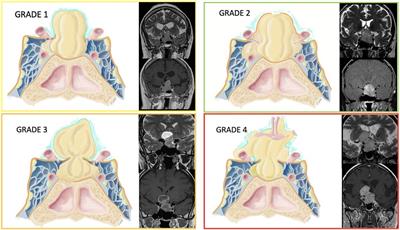 Relationship with the diaphragm to predict the <mark class="highlighted">surgical outcome</mark> in large and giant pituitary adenomas